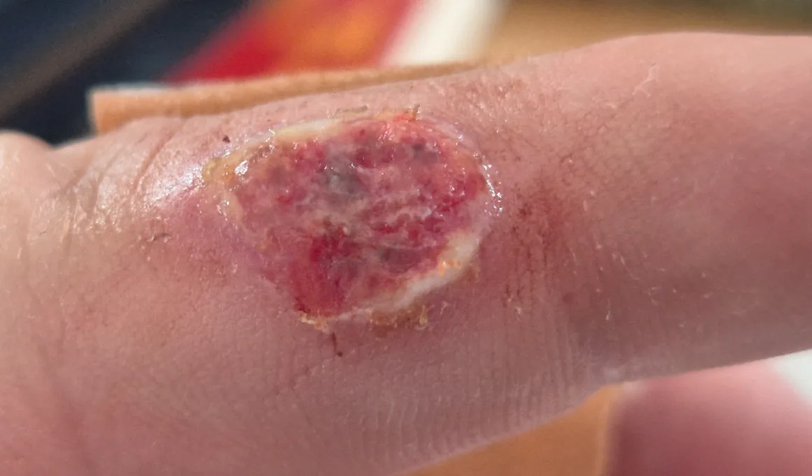 Im vorliegenden Fall hat sich ein J&auml;ger beim Aufbrechen eines St&uuml;ckes Muffelwild infiziert.