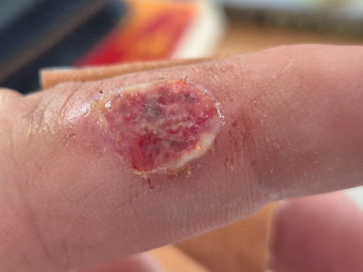 Im vorliegenden Fall hat sich ein J&auml;ger beim Aufbrechen eines St&uuml;ckes Muffelwild infiziert.