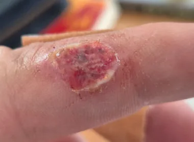 Im vorliegenden Fall hat sich ein J&auml;ger beim Aufbrechen eines St&uuml;ckes Muffelwild infiziert.