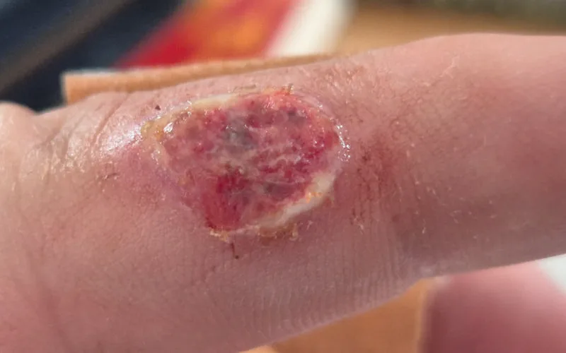 Im vorliegenden Fall hat sich ein J&auml;ger beim Aufbrechen eines St&uuml;ckes Muffelwild infiziert.